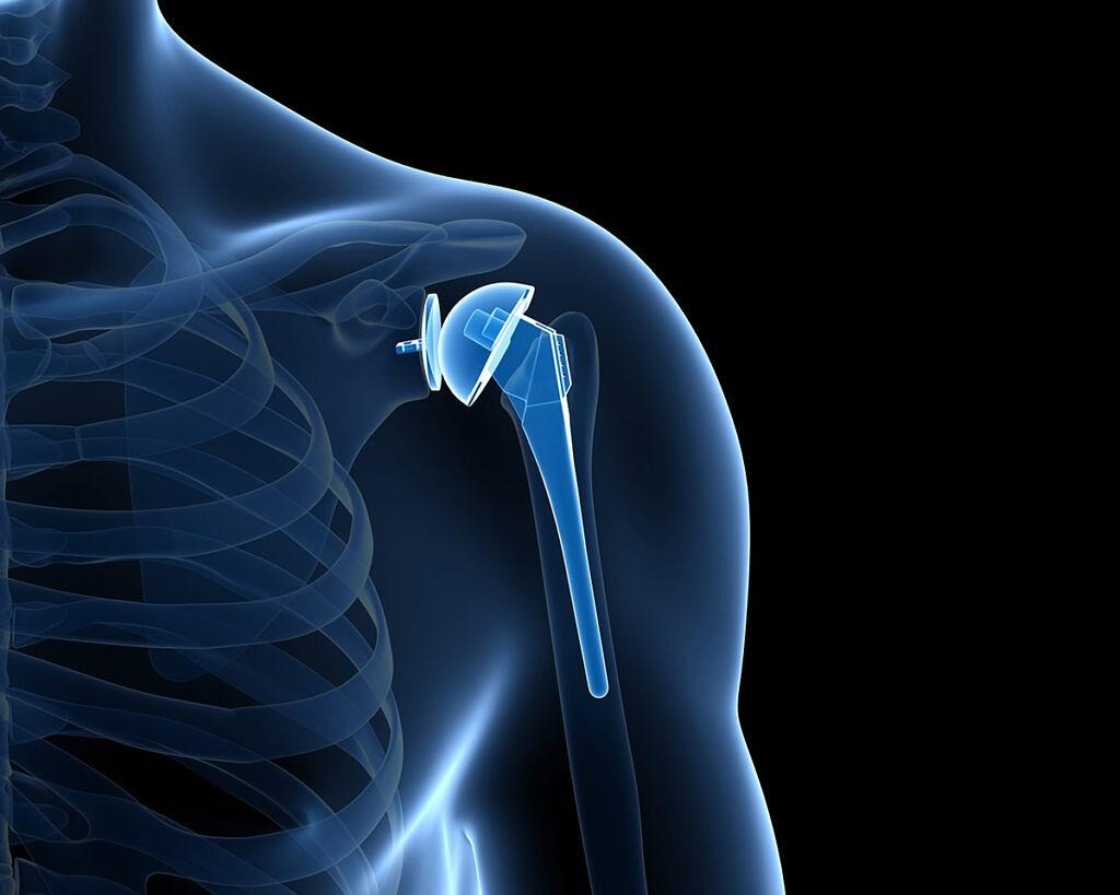 Reverse Total Shoulder Replacement Surgery in Delhi: A Modern Solution for Severe Shoulder Pain