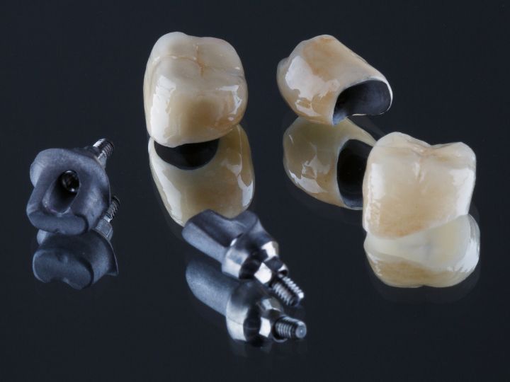 How Do You Know If Your Dental Crown Needs Replacement?