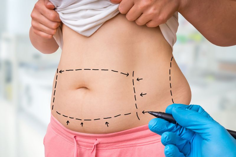Role of Liposuction in Tummy Tuck Procedures