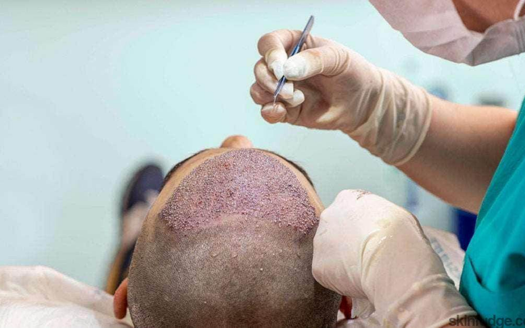 Get Natural Hair Restoration with FUE Hair Transplant in Islamabad