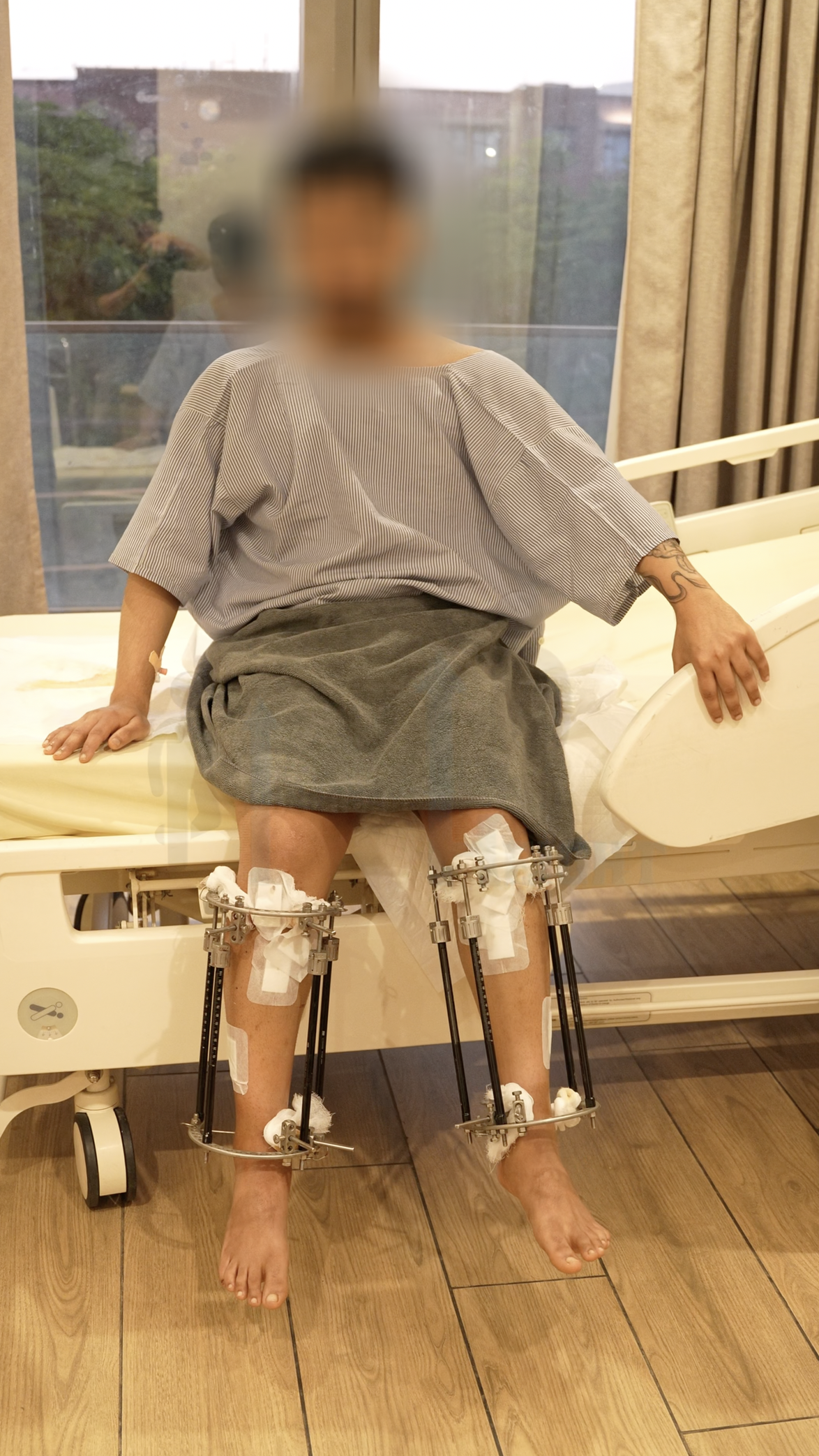 Is LON Limb Lengthening a Practical Option for Height Increase?