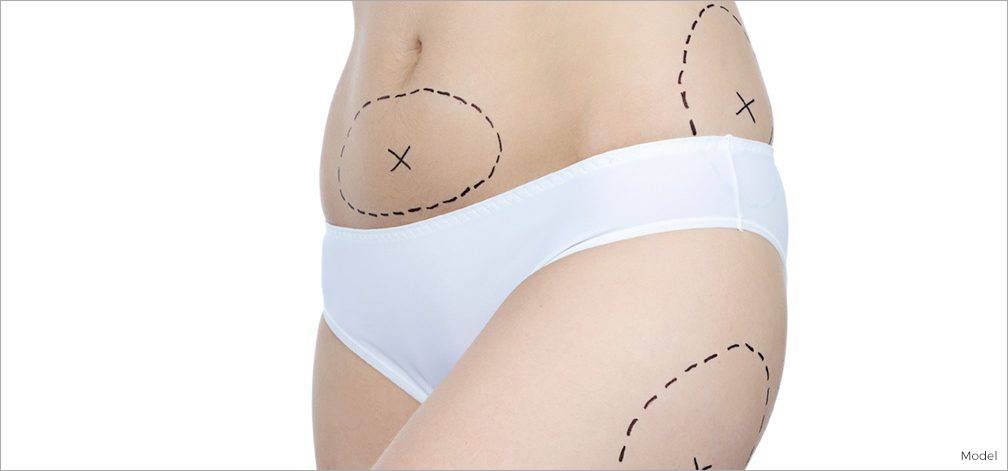 Fat Transfer Surgery for Volume Loss: A Complete Guide