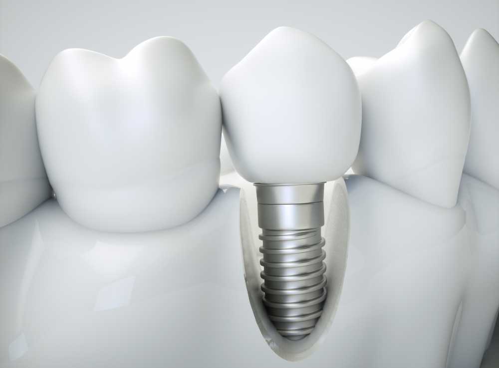 Dental Implants Worcester | Excellence-in-dentistry.co.uk