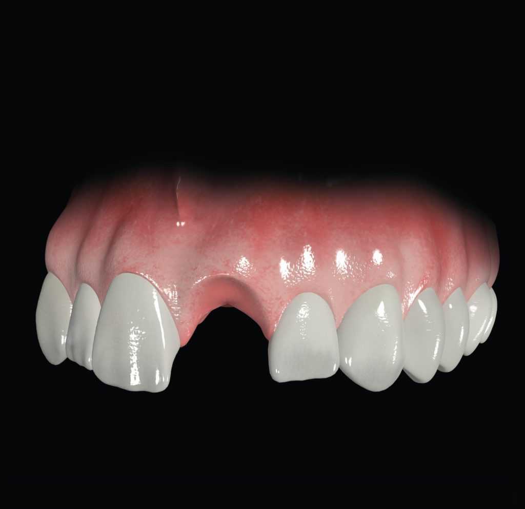 Dental Implants Worcester | Excellence-in-dentistry.co.uk