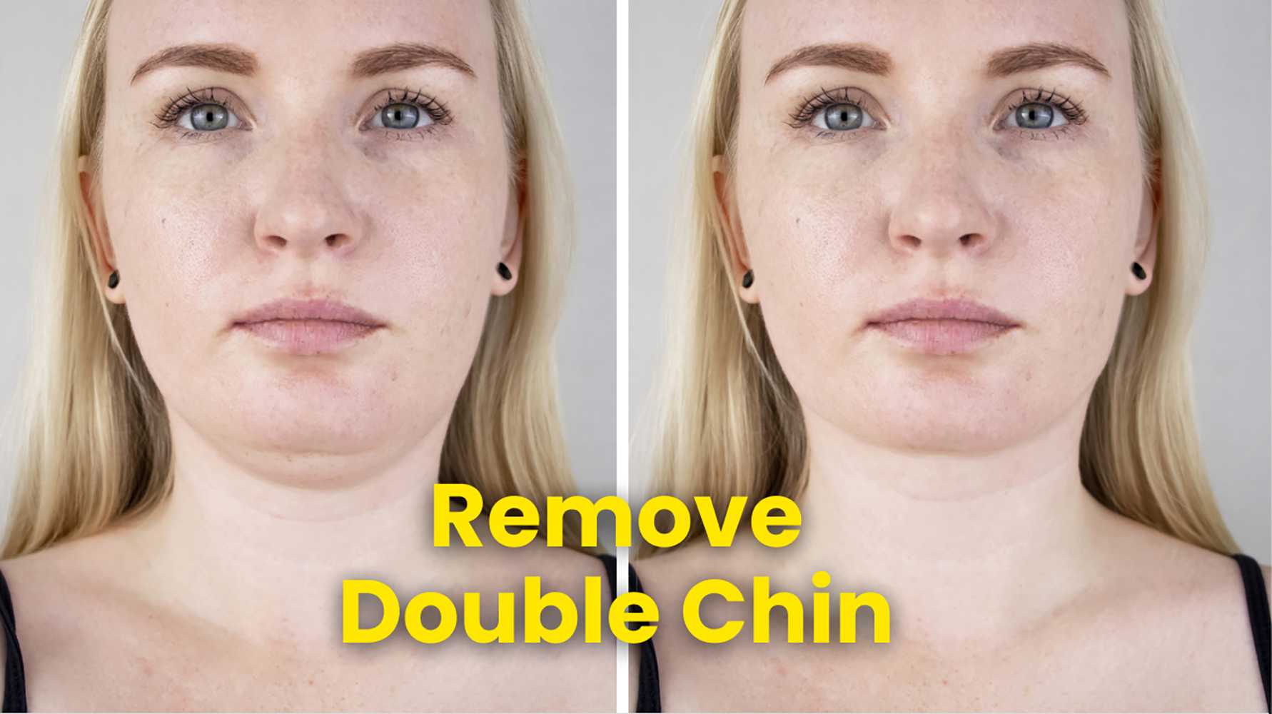 Remove double chin services