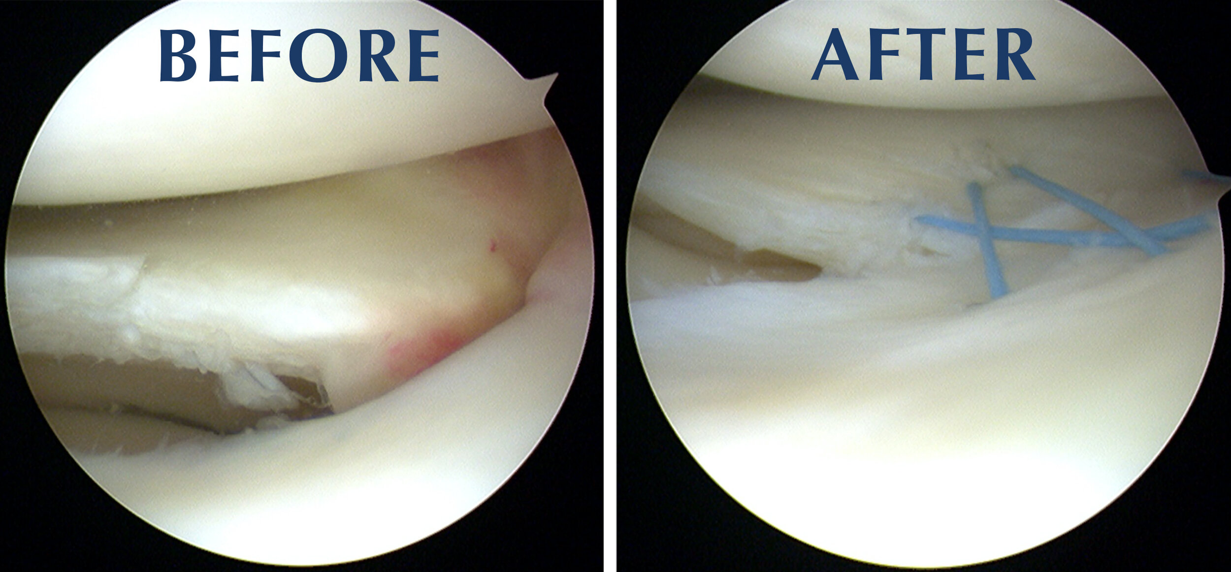 Restoring Comfort With Lateral Meniscus Tear Treatment